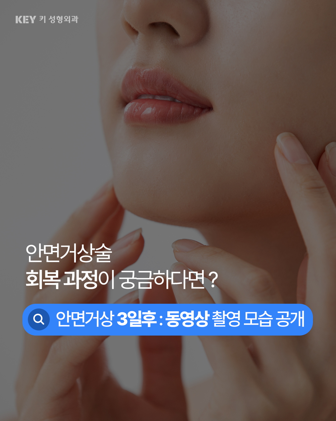 리얼 동영상 촬영 :안면거상술 3일후 회복과정