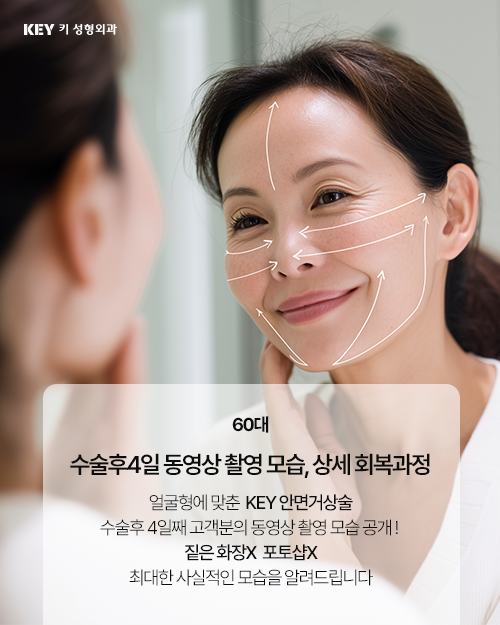 60대여자안면거상